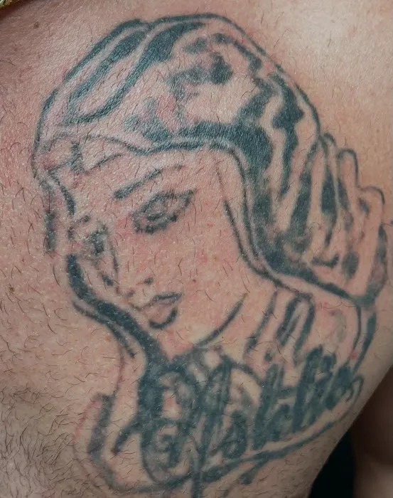 Erase Ink Laser Tattoo Removal Picture 10