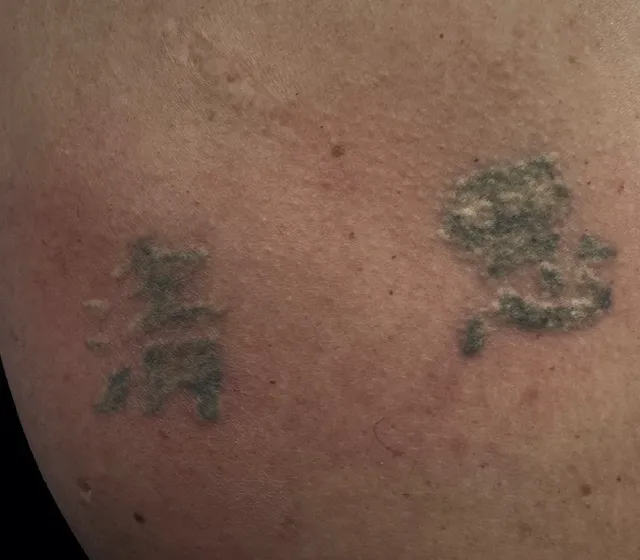 Erase Ink Laser Tattoo Removal Picture 2