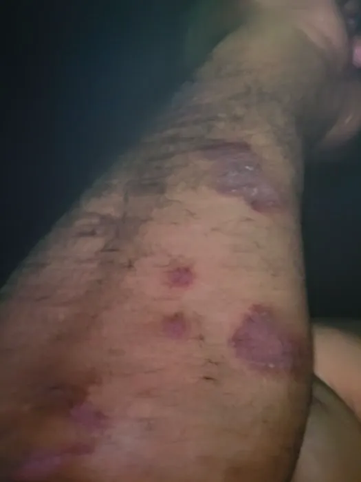 Cure psoriasis Picture 6