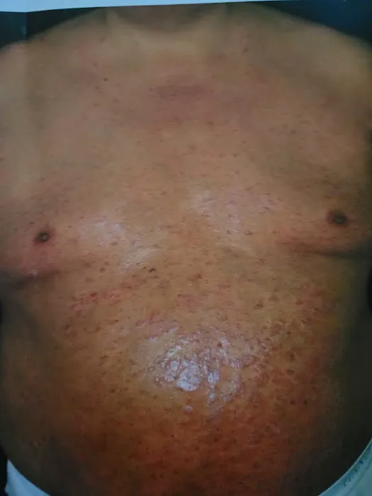Cure psoriasis Picture 7