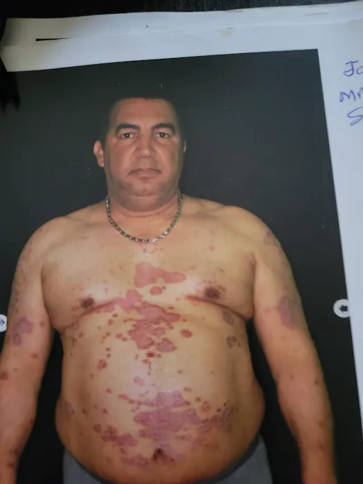 Cure psoriasis Picture 4