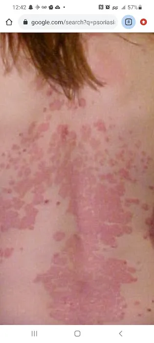 Cure psoriasis Picture 1