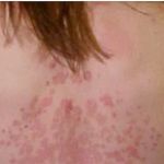 Cure psoriasis