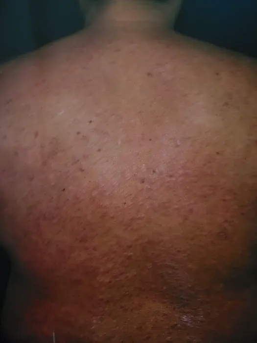 Cure psoriasis Picture 3