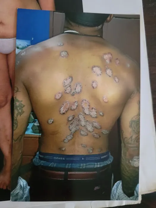 Cure psoriasis Picture 5