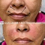 Silk Laser + Aesthetics Centre