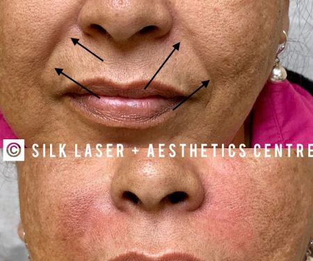 Silk Laser + Aesthetics Centre