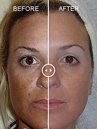 DermaTransformation: facial resurfacing and non-surgical lifting Picture 2