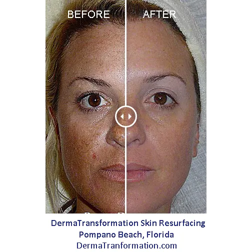 DermaTransformation: facial resurfacing and non-surgical lifting Picture 3