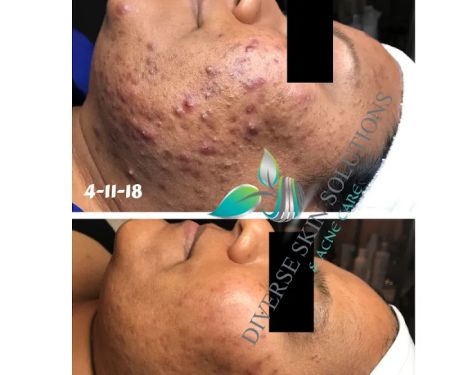 Diverse Skin Solutions & Acne Care