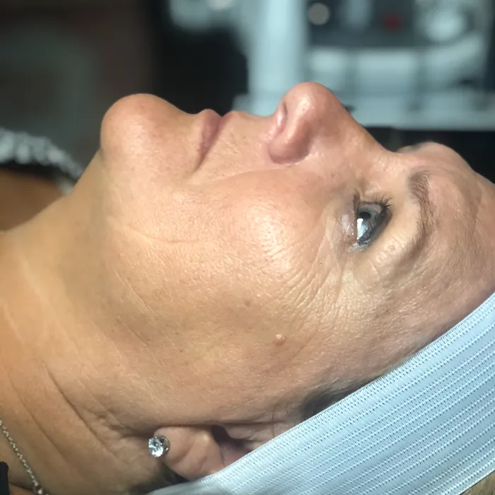 BareFace Aesthetics - Facial Spa & Skin Treatment Picture 8