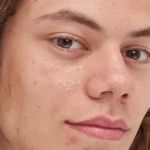 Best Practices for Using Hyaluronic Acid to Improve Blackheads