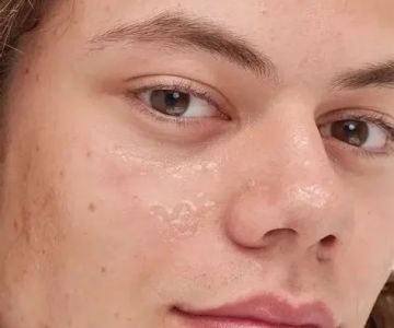 Best Practices for Using Hyaluronic Acid to Improve Blackheads