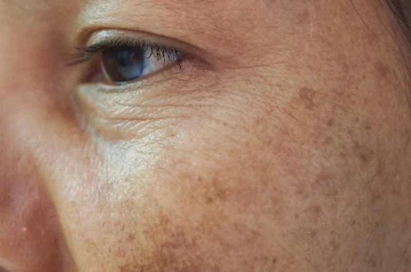 Expert Advice On Dark Spots: What You Need To Know