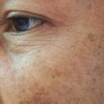 Expert Advice On Dark Spots: What You Need To Know