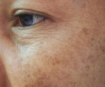 Expert Advice On Dark Spots: What You Need To Know