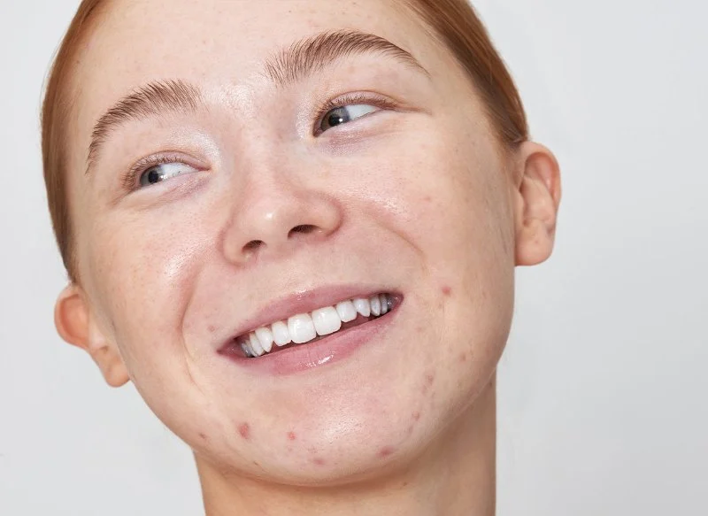 How to Prevent Redness Effectively – Skincare Expert Guide