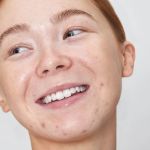 How to Prevent Redness Effectively – Skincare Expert Guide