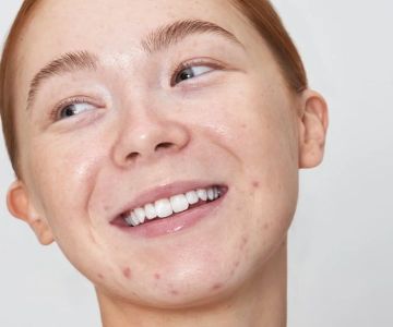 How to Prevent Redness Effectively – Skincare Expert Guide