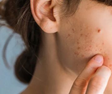 How To Prevent Scars With A Simple Routine