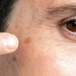 How To Detoxify Dark Spots In People With Oily Skin