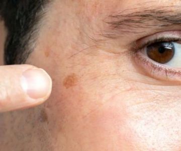 How To Detoxify Dark Spots In People With Oily Skin