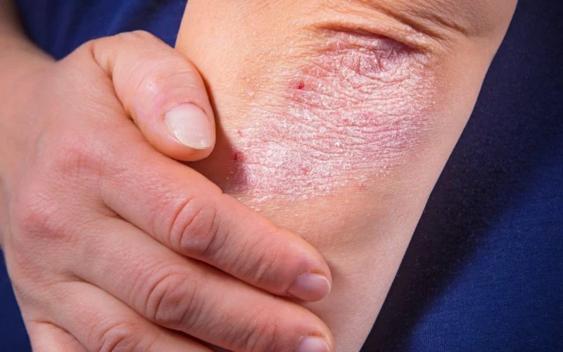 Guide to Skin Care Treatments for Eczema With a Simple Routine