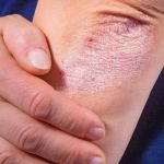 Guide to Skin Care Treatments for Eczema With a Simple Routine