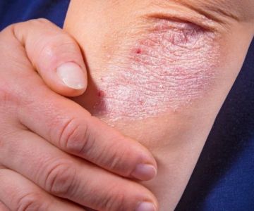 Guide to Skin Care Treatments for Eczema With a Simple Routine