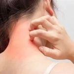 Common Mistakes in Eczema Using Natural Remedies You Should Avoid