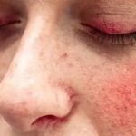 How To Heal Your Redness With These 5 Proven Skin Tips