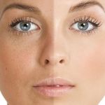 How to Get Rid of Uneven Skin Tone for People Living in Dry Climates