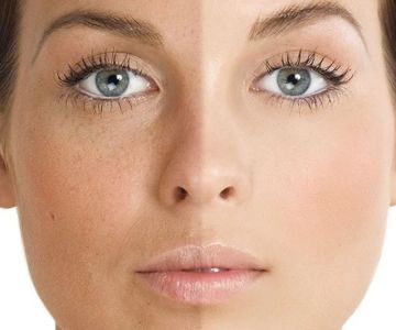 How to Get Rid of Uneven Skin Tone for People Living in Dry Climates