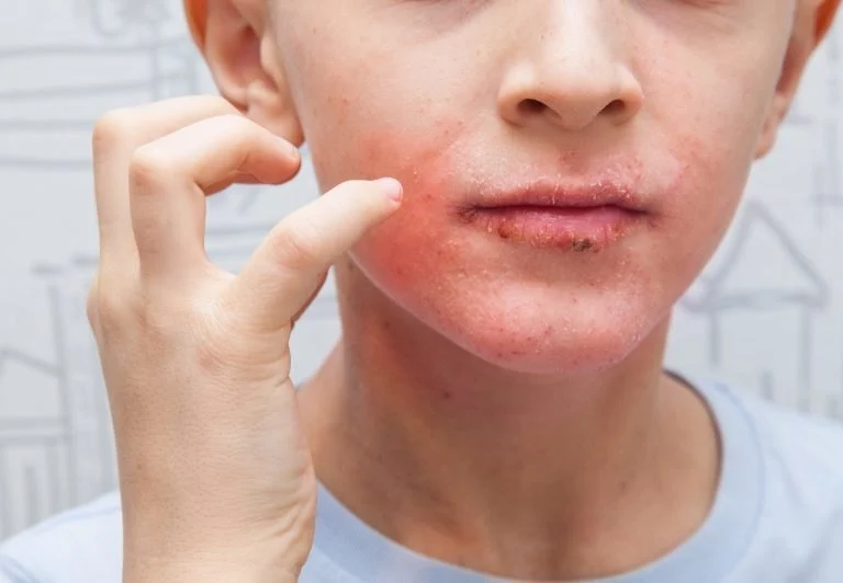 How to Boost Your Skin's Eczema for Teens