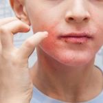 How to Boost Your Skin's Eczema for Teens
