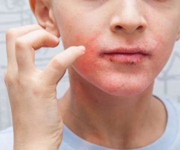 How to Boost Your Skin's Eczema for Teens