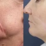 How to Repair Scars in People Over 40: Expert Skincare Insights