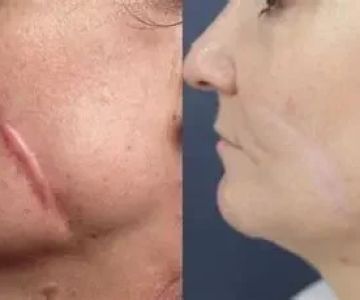 How to Repair Scars in People Over 40: Expert Skincare Insights