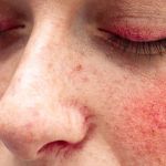 How To Choose the Right Solution for Your Redness With These 7 Tips