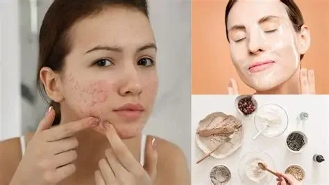Ultimate Guide to Face Masks to Improve Acne