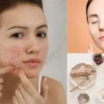 Ultimate Guide to Face Masks to Improve Acne