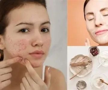 Ultimate Guide to Face Masks to Improve Acne