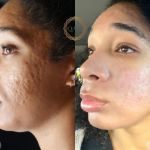 How To Repair Scars In People Over 40