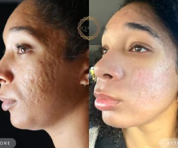 How To Repair Scars In People Over 40