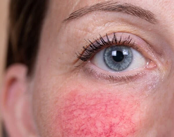 Effective Tips for Sensitive Skin with Redness in Teens