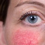 Effective Tips for Sensitive Skin with Redness in Teens