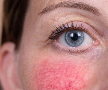 Effective Tips for Sensitive Skin with Redness in Teens