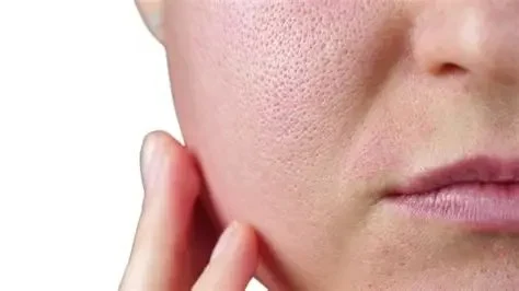 How To Achieve Large Pores: What You Need To Know