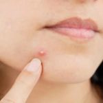 Daily Skin Care Routine For Your Whiteheads With These 15 Tips | SkinCare Experts