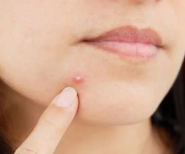 Daily Skin Care Routine For Your Whiteheads With These 15 Tips | SkinCare Experts